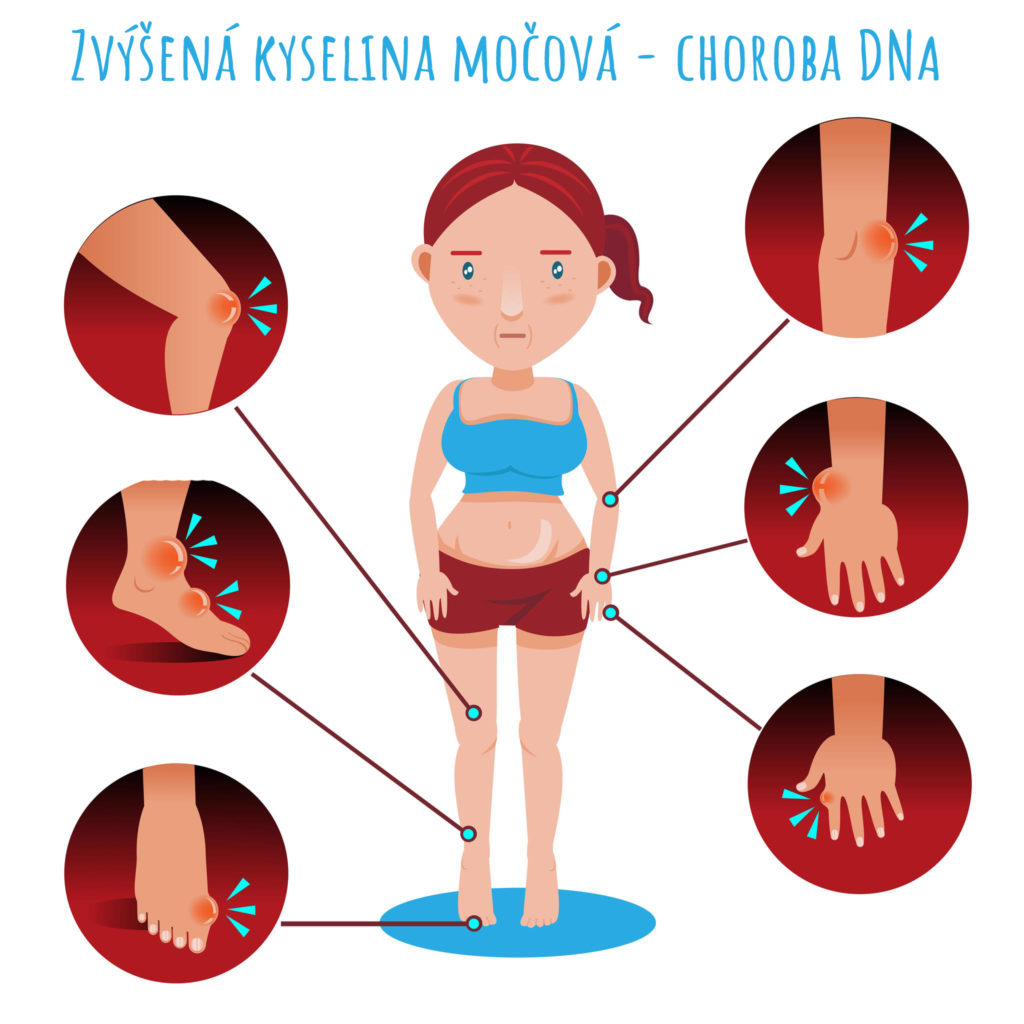 kyselina močová DNA choroba