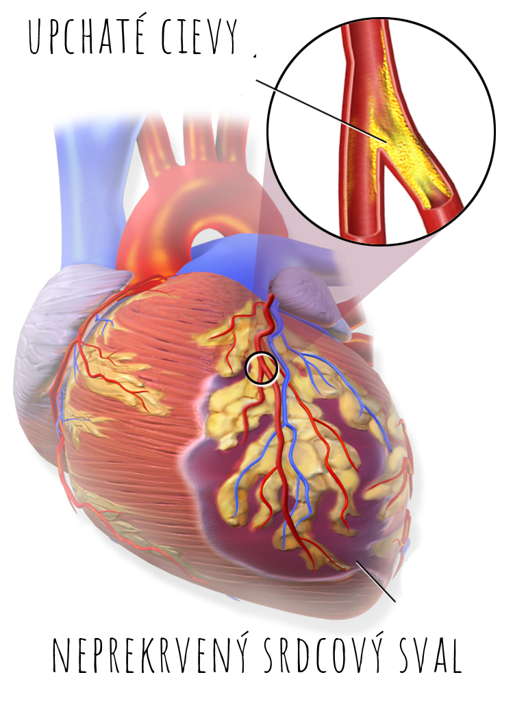 srdcový infarkt upchaté cievy