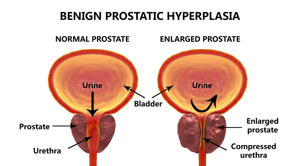 zväčšená prostata